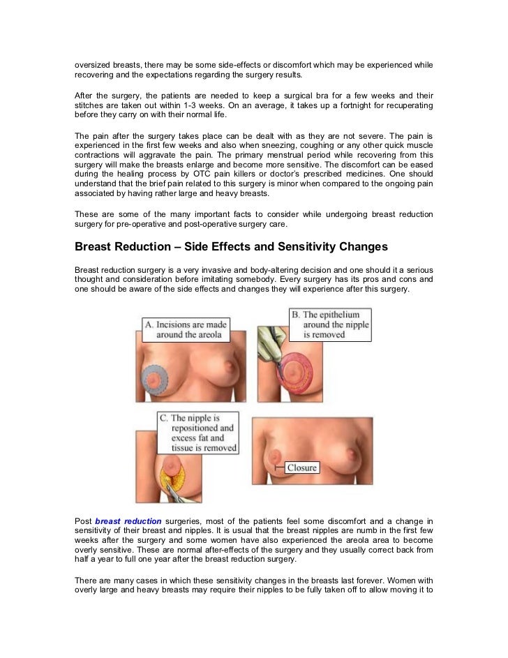 breast reduction side effects Breast reduction side effects